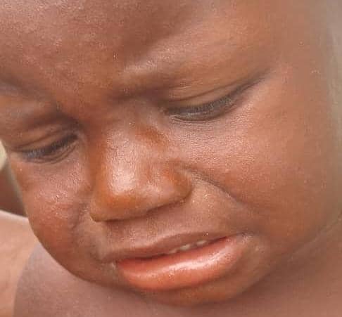 Sud-Kivu : La rougeole tue à Shabunda, une zone isolée !